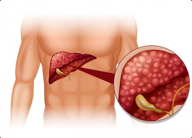 Fatty Liver Treatment in Paschim Vihar