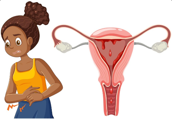 Homeopathic Treatment for Uterine Fibroids in Paschim Vihar
